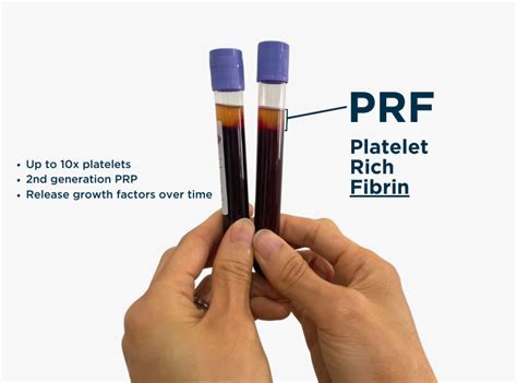 Prf Injections For Hair Loss And Skin Treatments