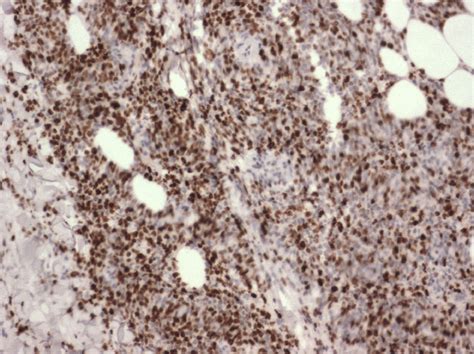 Primary cutaneous DLBCL, leg type