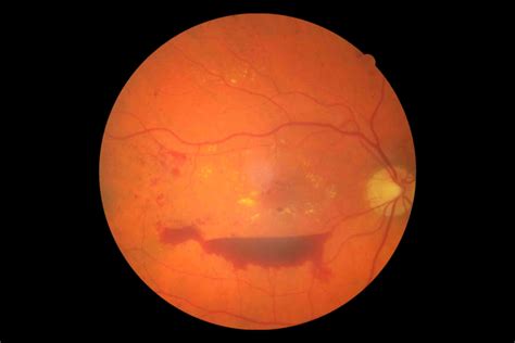 diabetic retinopathy 3 - Eyes Wide Bay