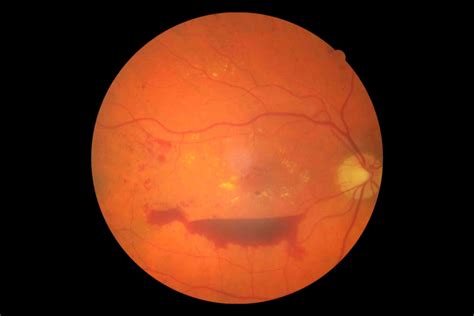 Diabetic Retinopathy 3 Eyes Wide Bay