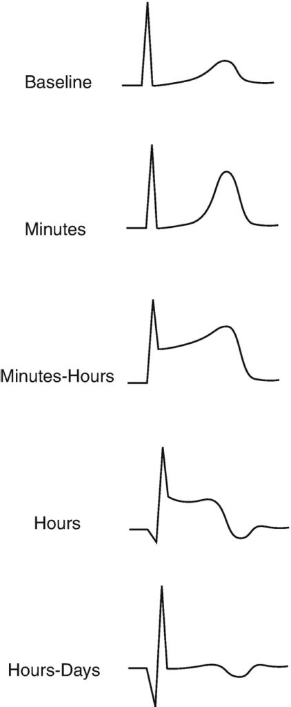 Ekg Part 7 Elevasi Segmen St Dan Penemuan Lain Pada Infark Miokard Difusi Review