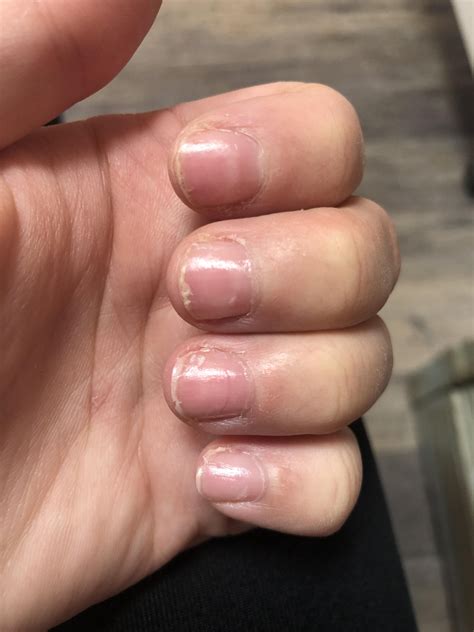 Effects Of Nutrient Deficiency On The Nails What Do They Indicate About