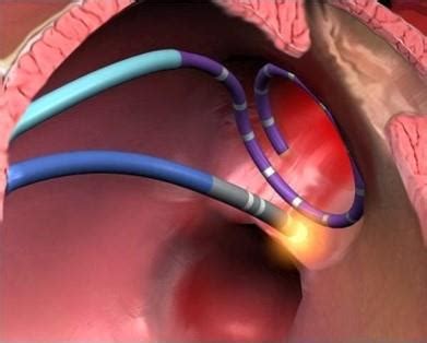 Una Nueva Tecnolog A Espa Ola Aumenta La Eficiencia En El Tratamiento