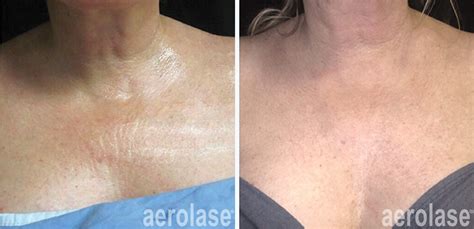 Aging Skin Before and After Gallery • Aerolase