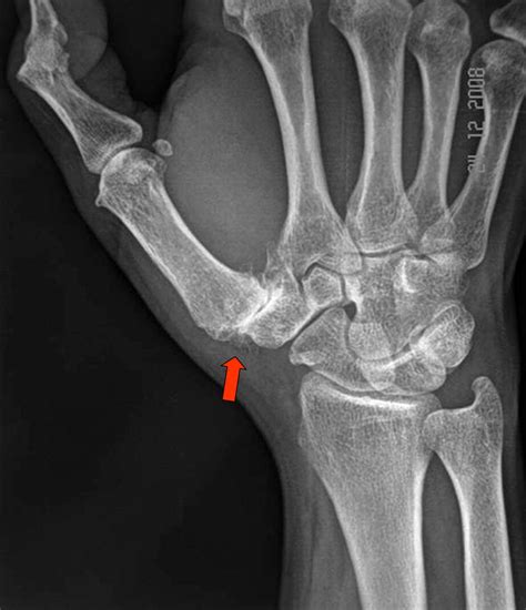 Rehabilitation Protocol After Suspension Arthroplasty Of Thumb Carpometacarpal Joint