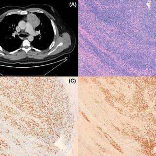 Panel A CT scan showing an anterior mediastinal mass. Panel B Mass ...