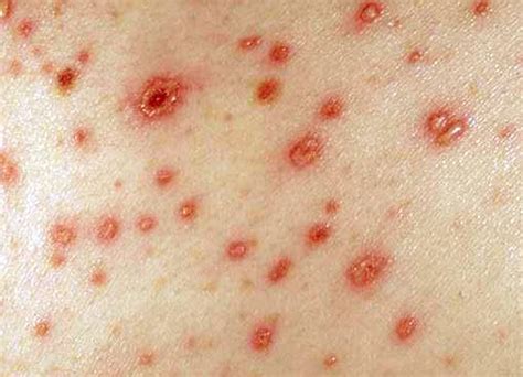 Hiv Rash Ihealthmama