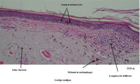 Dermpath Made Simple - Neoplastic: Lentigo Maligna