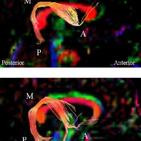 Dti Demonstrating Left Arcuate Fasciculus In Orange Of Patient Upper