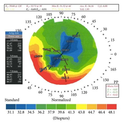 Corneal Topography Progression Of Corneal Topography Measured In