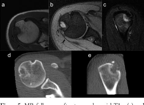 Figure From Humeral Greater Tuberosity Osteolysis As A Complication