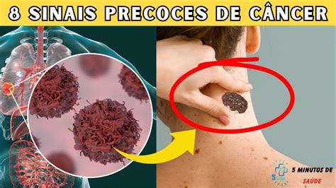 Consulte Um Médico Imediatamente Se Você Tiver Estes 8 Sinais De Alerta Precoce De Câncer Youtube