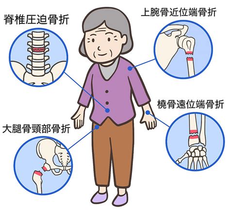 看護師が解説！高齢者の骨折予防①高齢者に多い骨折と原因 さぽくる