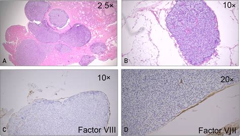 Late Recurrence Of Hyperparathyroidism Parathyromatosis Or Recurrent