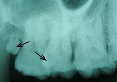 Pre Operative Right Side Intra Oral Peri Apical Radiograph Showing