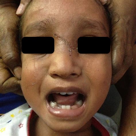 A Comminuted Nasal Fracture With Laceration B Fracture Reduced