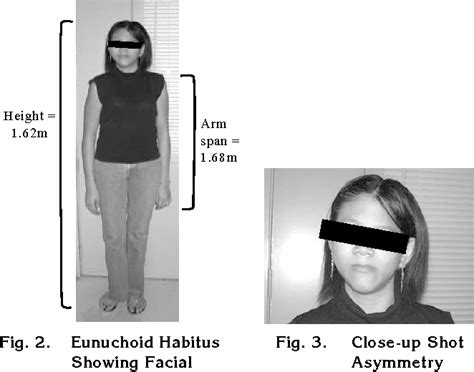 Table I From Primary Empty Sella With Partial Hypopituitarism And