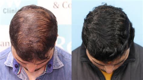 Best Hair Transplant Result 2021 Diffuse Pattern 4478 Grafts Regrow Clinic Haridwar