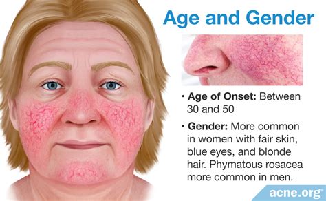 Acne Vs Rosacea