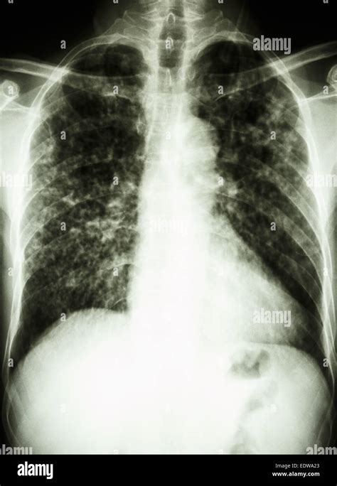 Film Radiografía De Tórax Muestra Infiltrado Intersticial Pulmonar