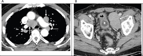 A Pictorial Review Of The Less Commonly Encountered Patterns Of Metastatic Prostate Carcinoma