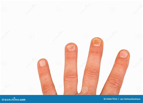 Nail Fungus On The Toenails And Skin Spots Stock Photography