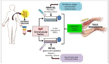 Rbcp Adipose Tissue Derived Stem Cell Autologous Grafts A New