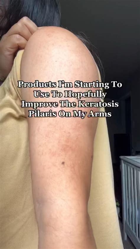 How To Get Rid Of Keratosis Pilaris On Arms Legs Strawberry Skin Artofit