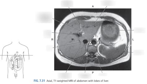 Axial Mri Of Abdomen With Lobes Of Liver Diagram Quizlet