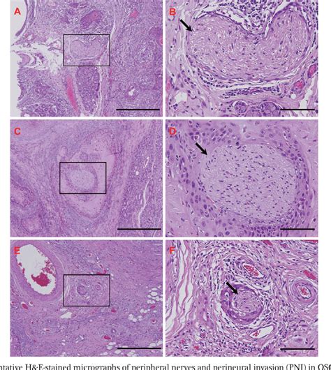 [pdf] Clinical Significance Of Perineural Invasion In T 1 2 Oral Cavity