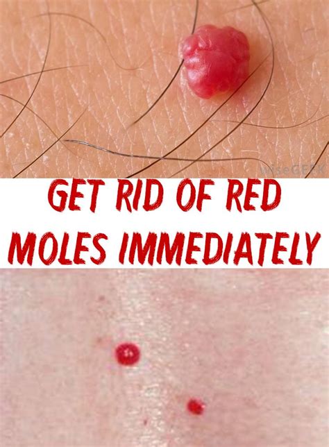 How To Remove Red Moles Naturally HOWOTREMVO