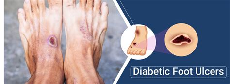 Diabetic Foot Ulcer Causes | Endocrinologist Dr. Moxit Shah