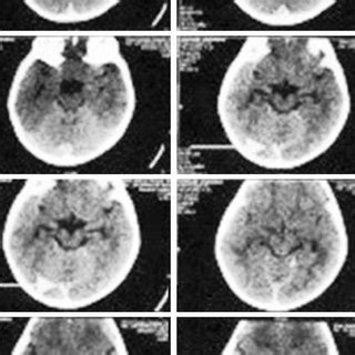 ct scan brain showing calcification  falx cerebri