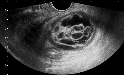 Dermoid Ovarian Cyst Ultrasound