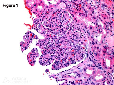 Cryoglobulinemic Glomerulonephritis Teaching Point Arkana Labs