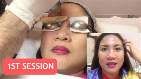 My First Fractional Co2 Laser Experience Vlog 30 Dyn💛 Youtube