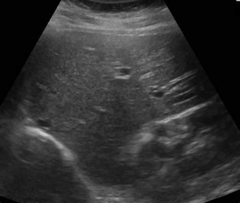 Abdomen And Retroperitoneum 1 1 Liver Case 1 1 1 Focal Nodular