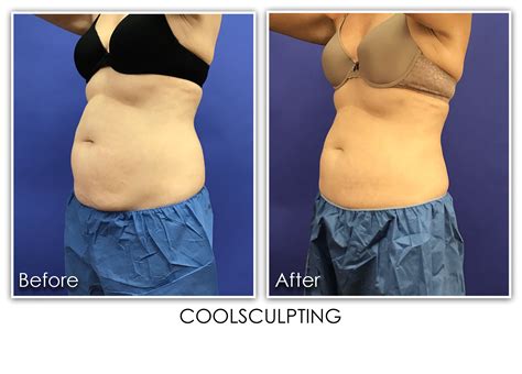 Coolsculpting Pro Archives Skin Rejuvenation Clinic Skin Rejuvenation