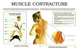 Muscle contracture – Anejo