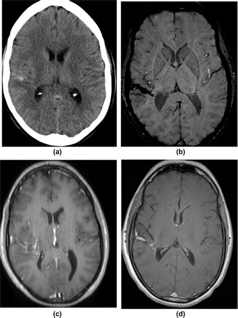 Clinical Manifestations And Imaging Findings Of Thrombosis Of