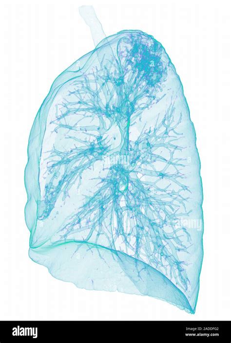 Pulmonary Tuberculosis Coloured Lateral 3D Computed Tomography CT