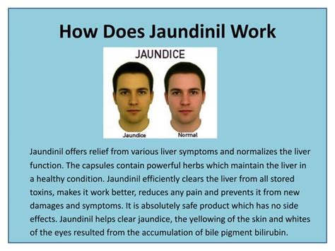 Natural Remedies for Jaundice Treatment | PPT