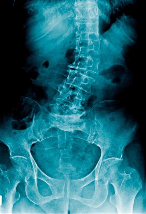 Top Non Surgical Scoliosis Treatment Options