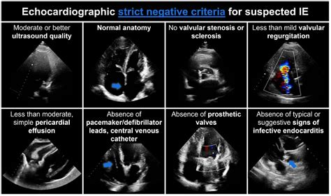 Infective Endocarditis Echo