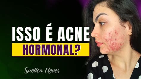 Acne Hormonal Como Saber Se VocÊ Tem E Por Quê Toda Acne é Hormonal