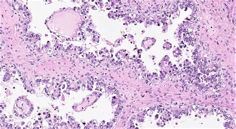 Pathology Outlines Clear Cell Carcinoma