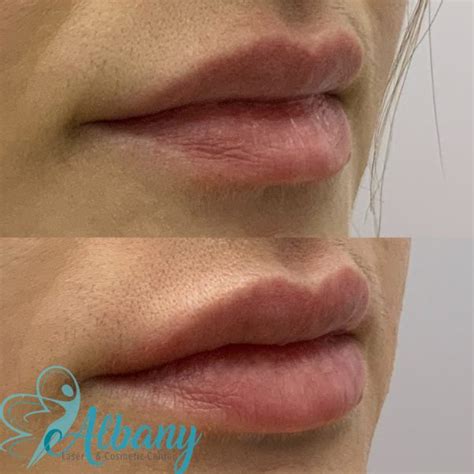 Lip Fillers Case No Albany Cosmetic And Laser Centre In Edmonton