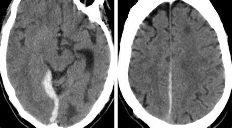 Subdural Hematoma SDH The Neurosurgical Atlas