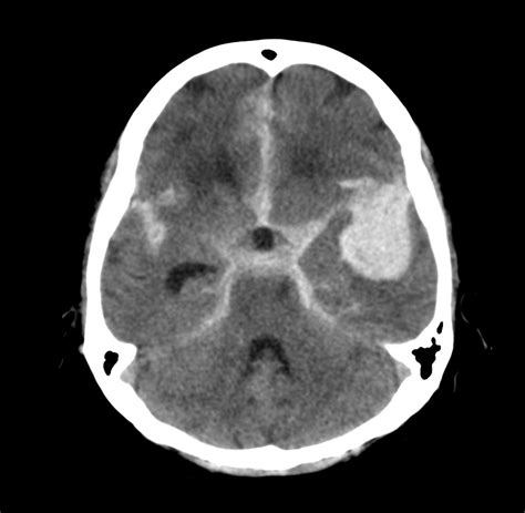 Subdural Haemorrhage Intracranial Haemorrhage Geeky Medics