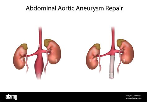 Abdominal Aortic Aneurysm Hi Res Stock Photography And Images Alamy